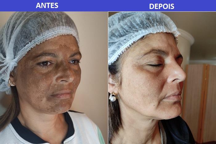 foto do rosto de uma mulher antes e depois com melasma