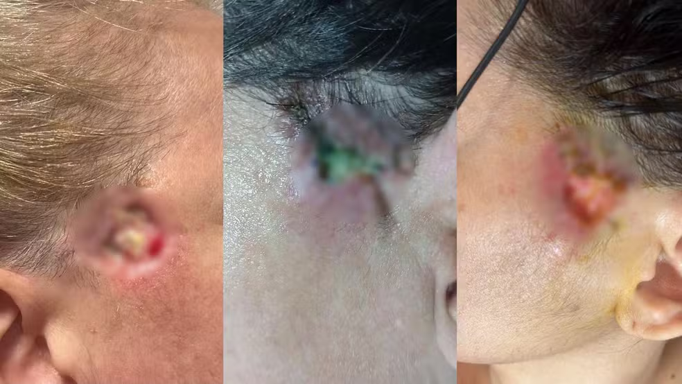 Mariana Laranja foi indiciada após pacientes relatarem deformidades e lesões após procedimento estético irregular no Espírito Santo