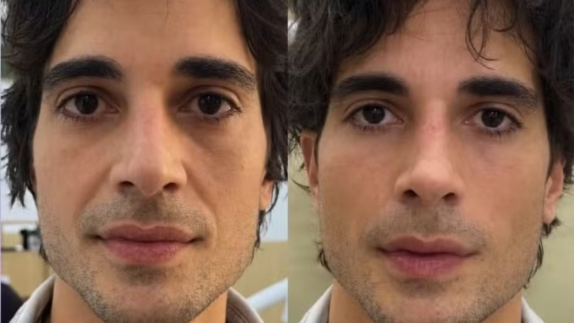 Fiuk antes e depois da harmonização facial, procedimento estético detalhado na reportagem