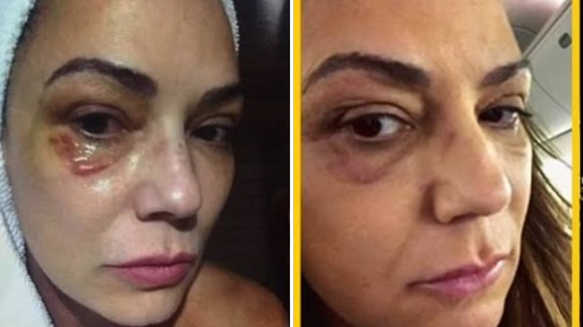 Luiza Brunet critica indenização de R$ 150 mil por agressão de ex: 'Reconhecer o dano'