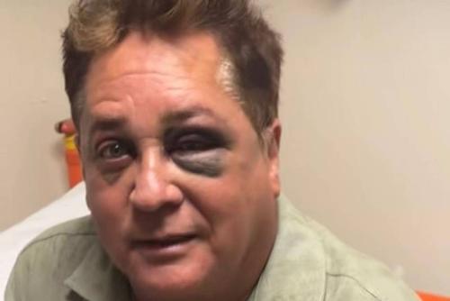 O cantor Leonardo sofre um acidente e apareceu com os olhos roxos e inchados