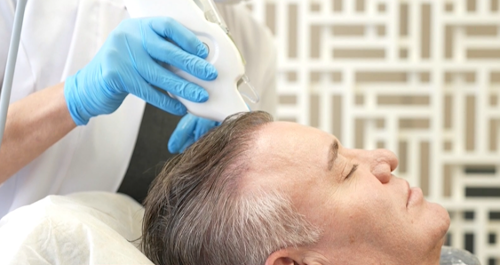 IMPLANTES CAPILAR E SEUS CUIDADOS
