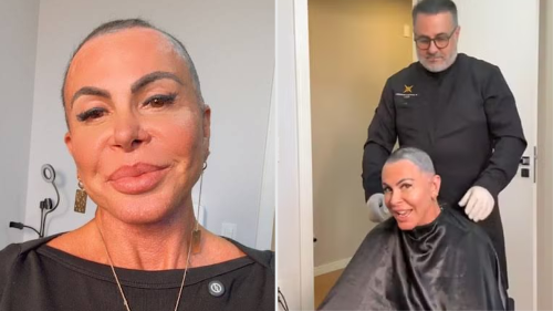 Gretchen raspa a cabeça e passa por transplante capilar para tratar alopecia no ES