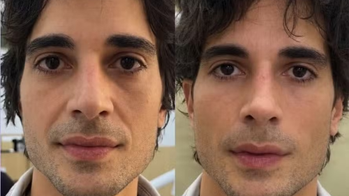 Fiuk antes e depois da harmonização facial, procedimento estético detalhado na reportagem